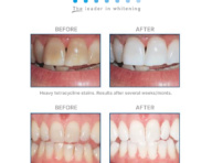 Opalesence Whitening Beforeafter Thehouseofmouth