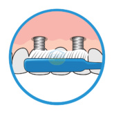 Bridgeimplant Floss Illustration Thehouseofmouth 04