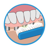 Bridgeimplant Floss Illustration Thehouseofmouth 04