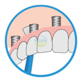 Bridgeimplant Floss Illustration Thehouseofmouth 04