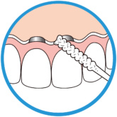 Bridgeimplant Floss Illustration2 Thehouseofmouth 01