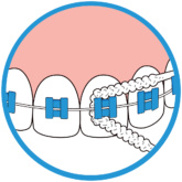 Bridgeimplant Floss Illustration3 Thehouseofmouth 01