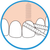 Bridgeimplant Floss Illustration Thehouseofmouth 01