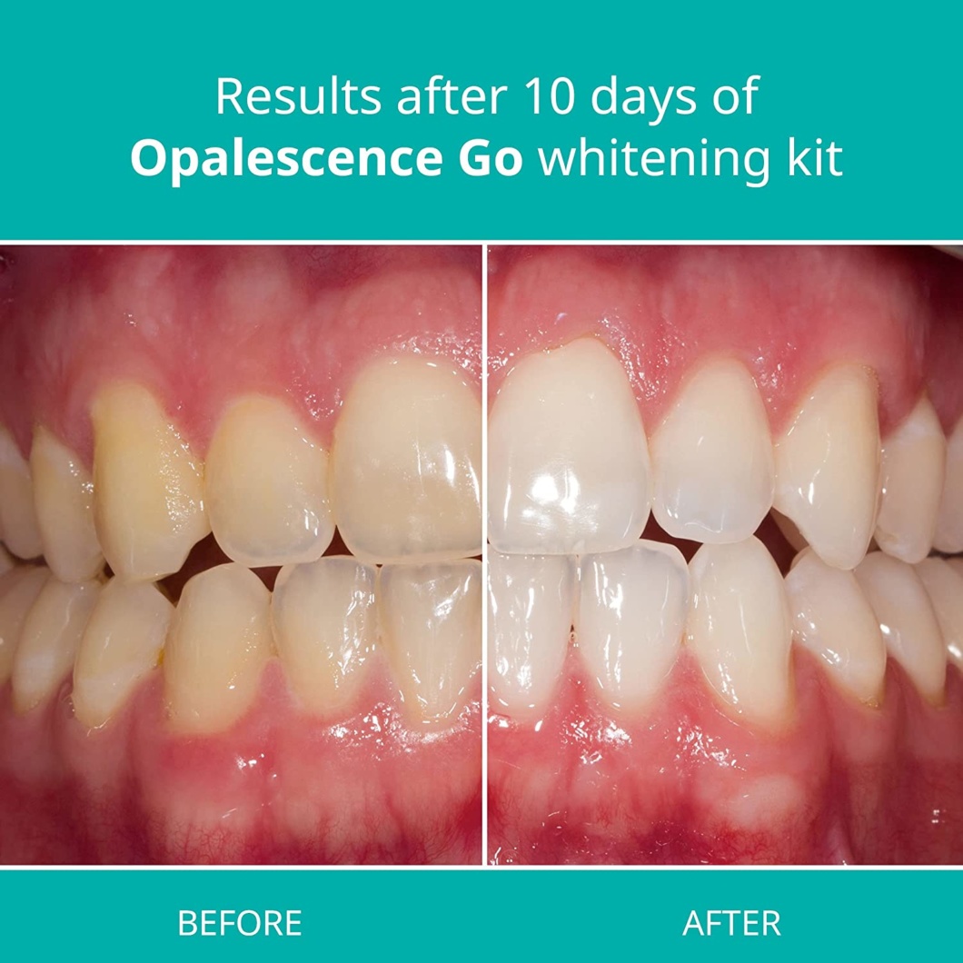Opalescence Go teeth whitening kit before and after comparison