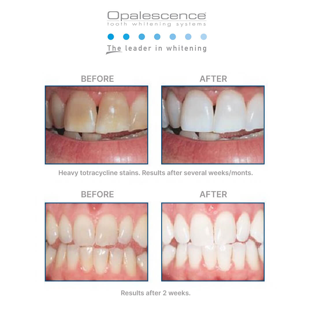 Opalesence Whitening Beforeafter Thehouseofmouth