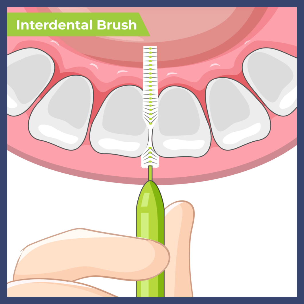 What Do Interdental Brushes Do