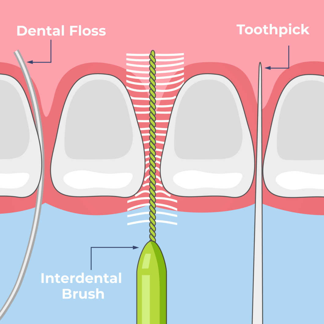 Why Do I Need To Floss