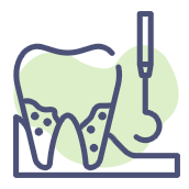 Removal Of Plaque And Tartar