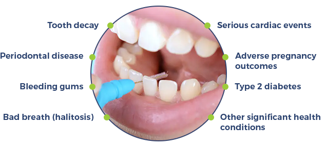 Interdental Picks