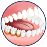 Image Of Jaw With Cavities