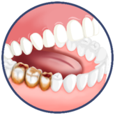 Image Of Jaw With Dental Caries