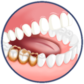 Image Of Jaw With Dental Caries