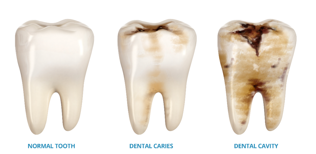 The Lifecycle Of A Decaying Tooth