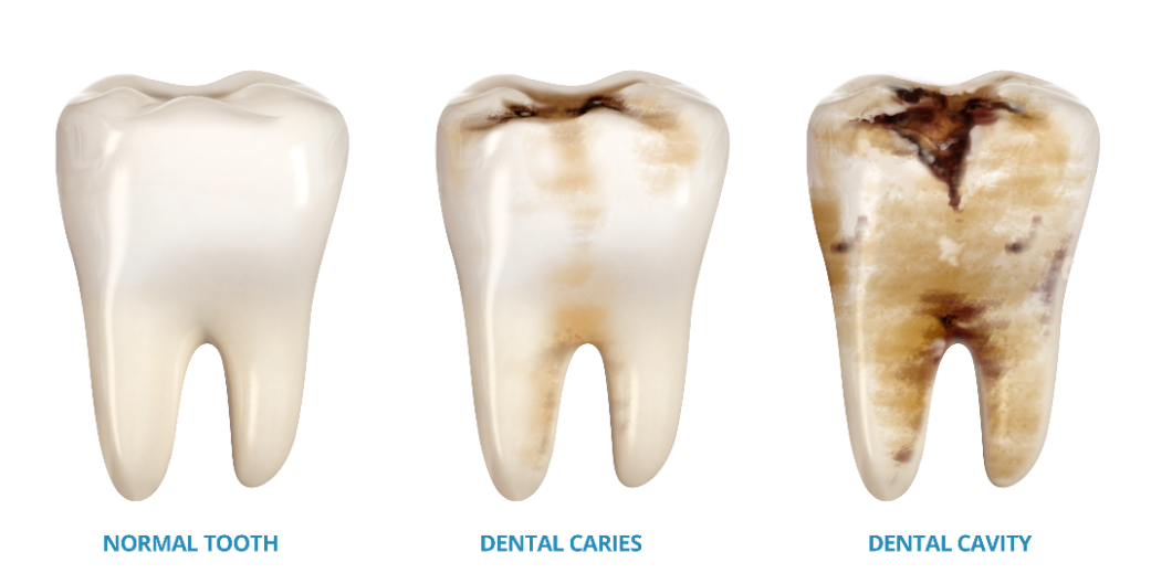 The Lifecycle Of A Decaying Tooth