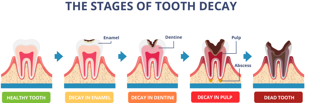 The Stages Of A Cavity