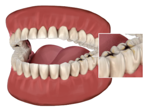 Dental Decay