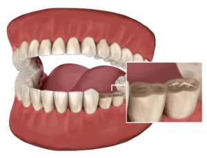 Grinding And Bruxism