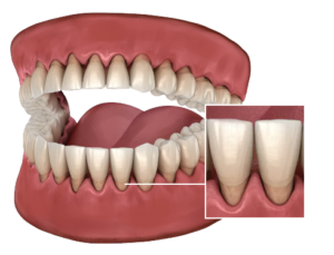 Gum Recession