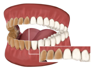 Sensitive Teeth And Teeth Whitening