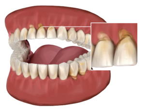 Toothbrushing Abrasion