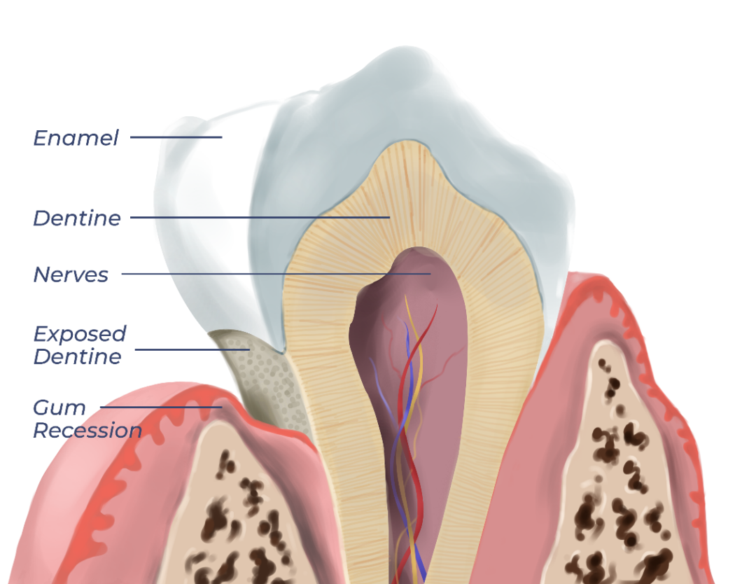 Sensitive Teeth Causes