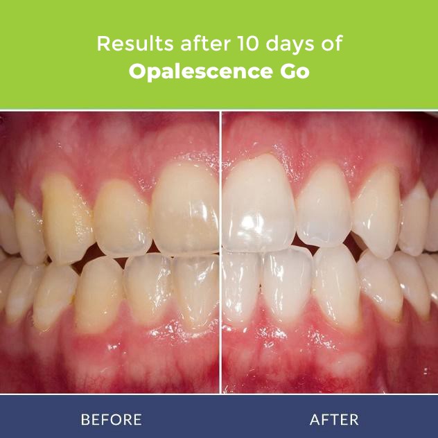 Results After 10 Days Opalescence Go