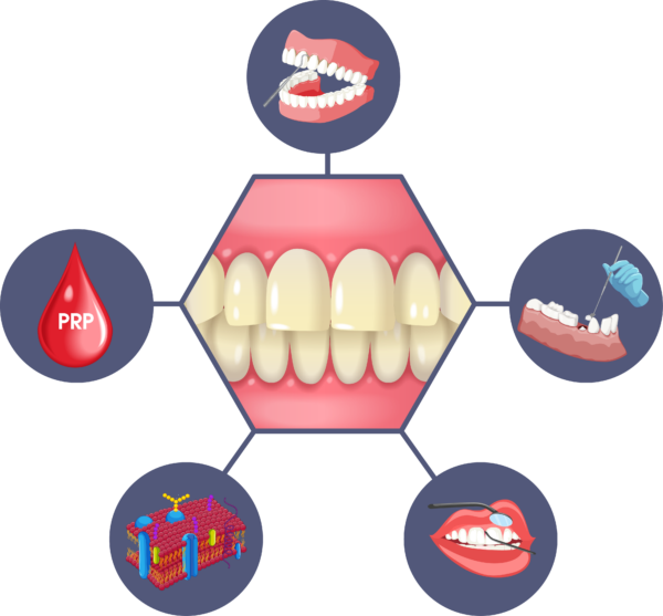 Surgical Periodontitis Treatments