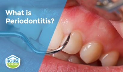Image Showing What Periodontitis Is