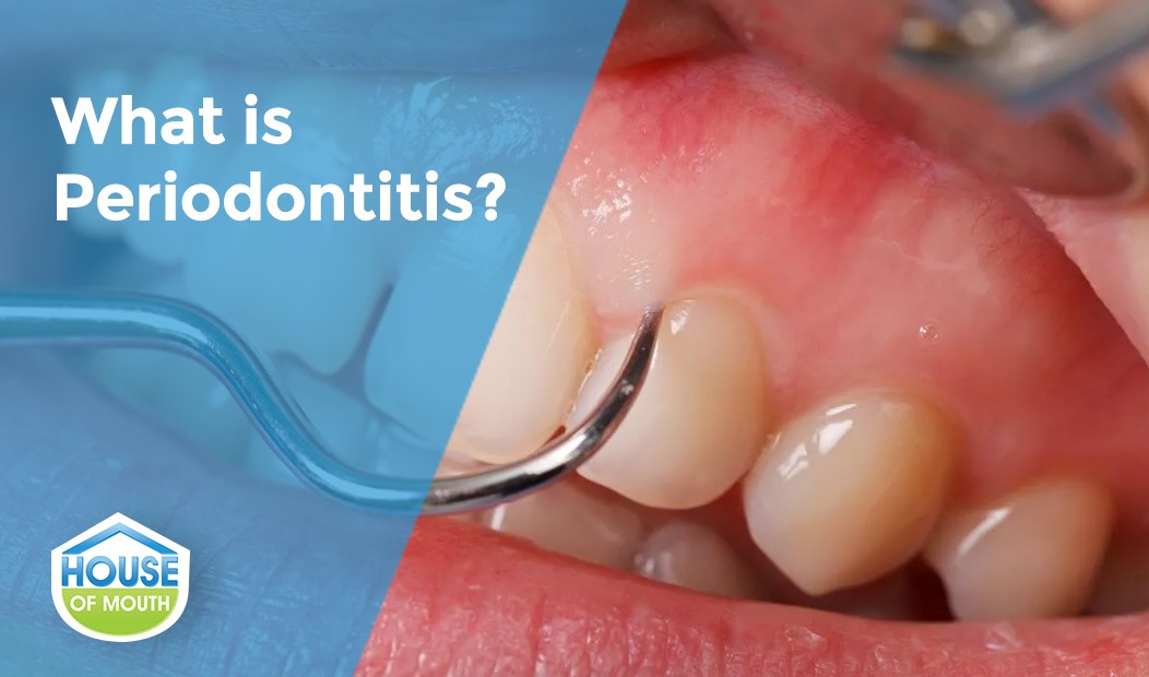 Image Showing What Periodontitis Is