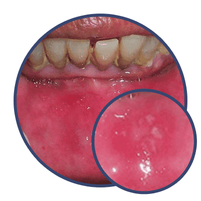 Mouth Ulcer 1