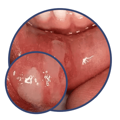Mouth Ulcer 2