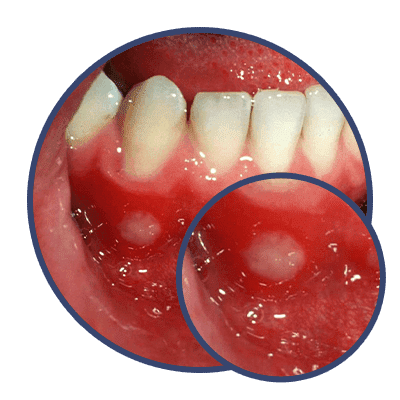 Mouth Ulcer 3