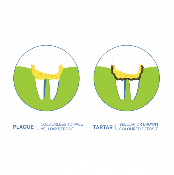 Remove Tartar From Teeth Illustration 01