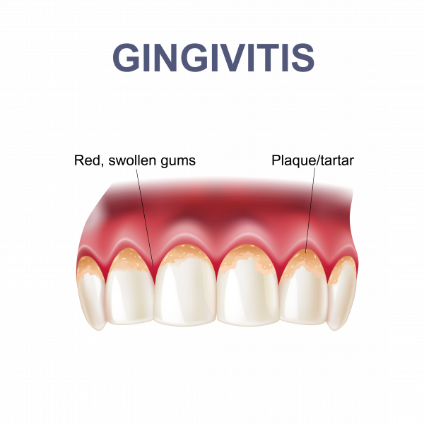What Is Gingivitis