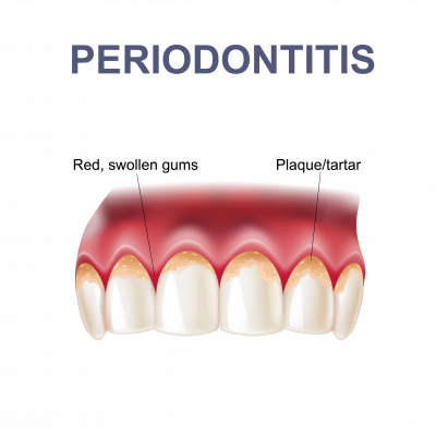 What Is Periodontitis