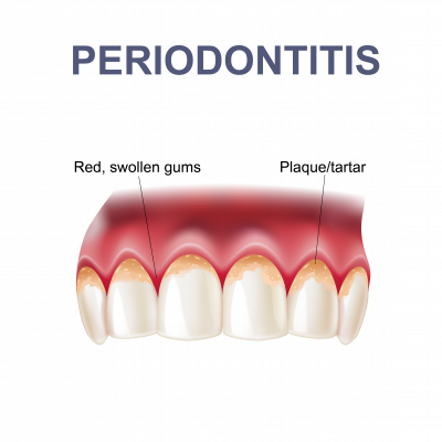 What Is Periodontitis